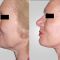 Facelift