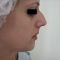 Operácia nosa (Rhinoplastika)