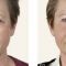 Kwas hialuronowy: Saypha, Restylane, Juvederm, Stylage