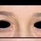 Cirugía de párpados (Blefaroplastia)