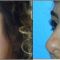 Blépharoplastie