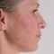 Age Spots Treatment