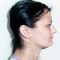 Operácia nosa (Rhinoplastika)