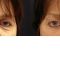 Brow lift