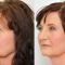 Eyelid surgery (Blepharoplasty)
