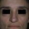 Rhinoplastie