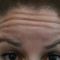 Hyperhidrose traitement (transpiration excessive) - Botox