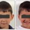 Operazione orecchie (Otoplastica)