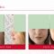 Rhinoplasty (Nose Job)