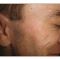 Nichtchirurgische Faltenbehandlung - BOTOX® / DYSPORT®