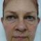 Ear surgery (Otoplasty)