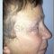 Facelift, SMAS Facelift