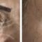 Botulinum toxin - Wrinkle Removal