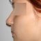 Plastika nosu (Rhinoplastika)