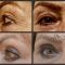 Operácia očných viečok (Blepharoplastika)