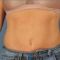 CoolSculpting