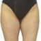 Liposuction