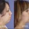 Chirurgie du double-menton