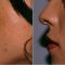 Lipofilling (grasso)