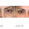 Eyelid surgery (Blepharoplasty)