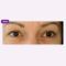 Operácia očných viečok (Blepharoplastika)