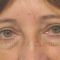 Operácia očných viečok (Blepharoplastika)