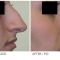 Rhinoplasty (Nose Job)