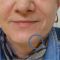 Facelift, SMAS facelifting